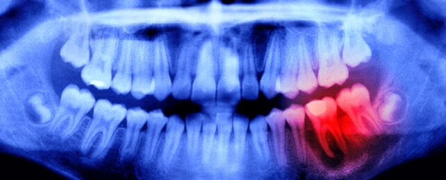 Mouth Xray Shows Red Sore Teeth