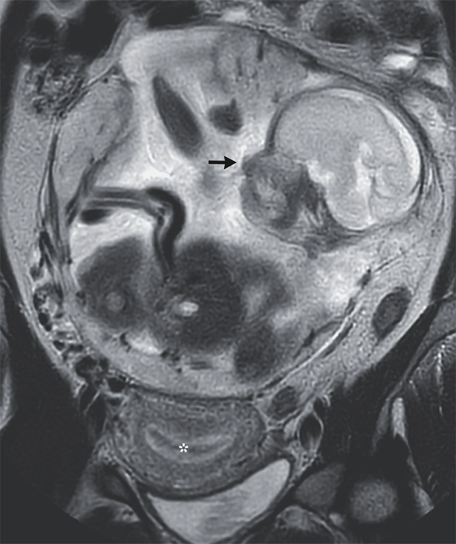 mri scan of ectopic pregnancy