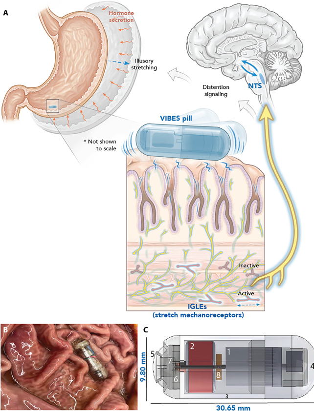 diagram of the VIBES pill stimulating nerves in the stomach