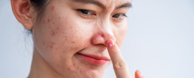 Asian woman looking displeased at pimple on her nose, inspecting it with her pointer finger.