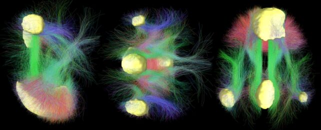 Default mode network connectivity shown aas colors between main regions