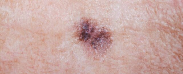 Powerful New Skin Cancer Therapy Cuts Risk of Death by Half