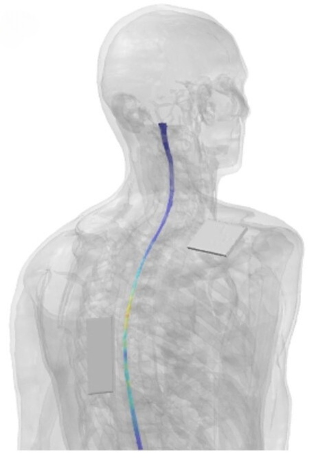 Virtual Reconstruction Spinal Cord Stim