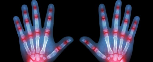 Child Hands Xray With Arthritis