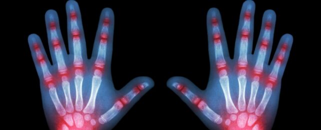 Child Hands Xray With Arthritis