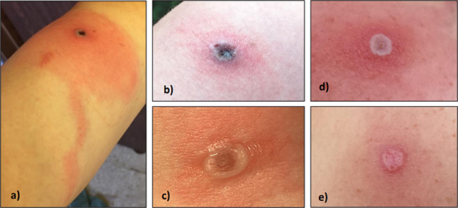 Lesion examples