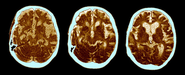 Alzheimer's brain scans