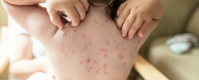 Child with red spots scratching their bare back while sitting on parent's lap.