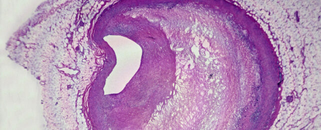 Tissue section of clogged coronary artery, stained purple as viewed under microscope.
