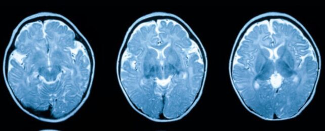 Younger Generations Have Larger Brains. Is That Healthier?