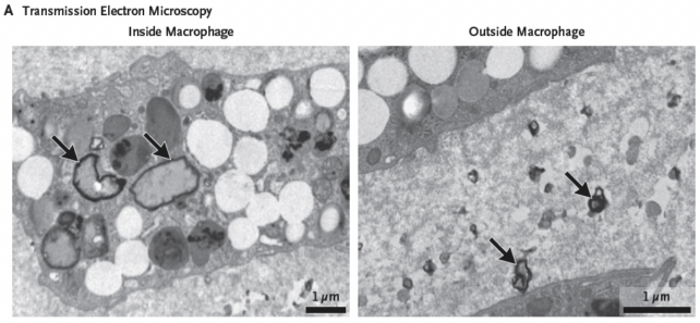 Panel dua gambar hitam putih menunjukkan partikel plastik bergerigi, ditandai dengan panah, di bagian jaringan, dilihat di bawah mikroskop.