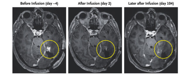 mri of patient 2's glioblastoma