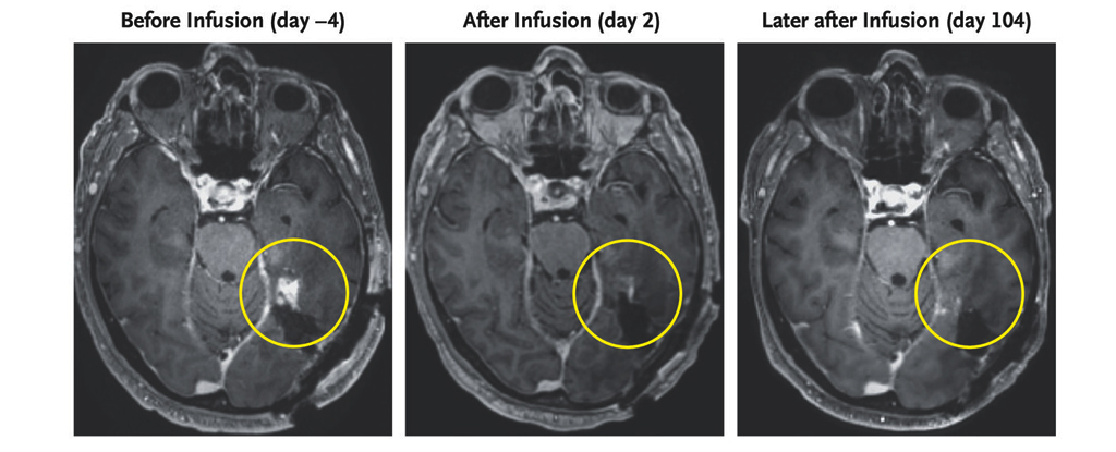 Una terapia innovadora destruye un tumor cerebral mortal en días: Heaven32