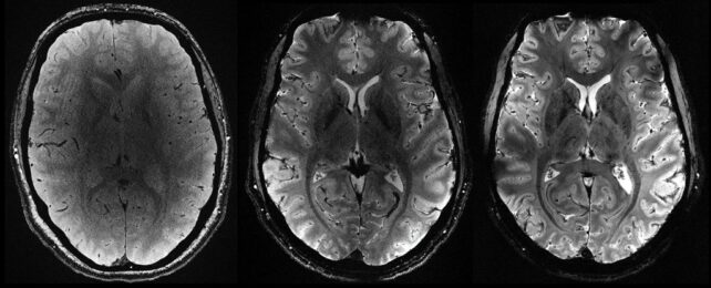 Brains MRIs