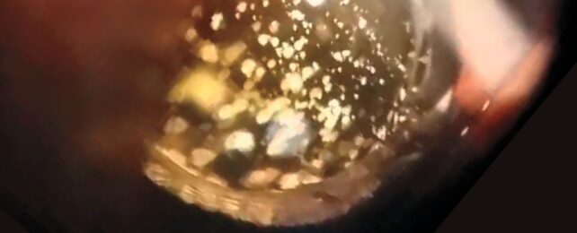Mysterious Condition Makes Human Eyes Sparkle Like a Galaxy