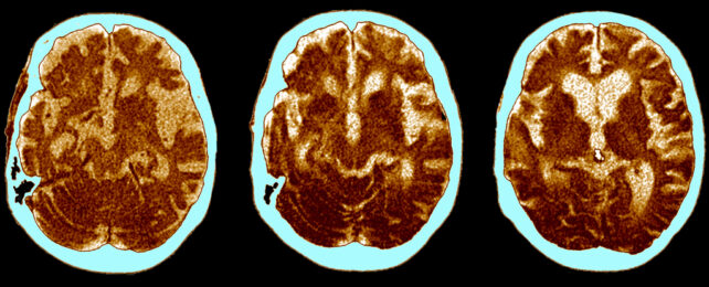 CT scans alzheimer's brains