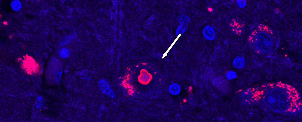 Causa genética de una rara enfermedad neurológica descubierta después de 25 años de investigación: ScienceAlert