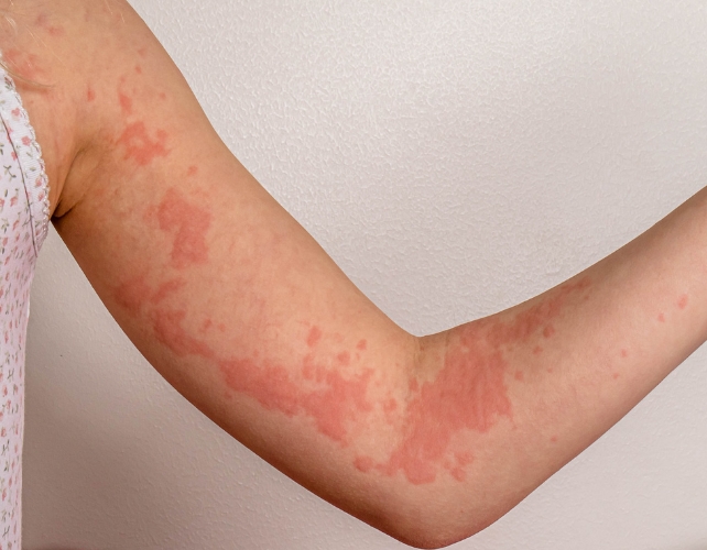 Hives on an arm