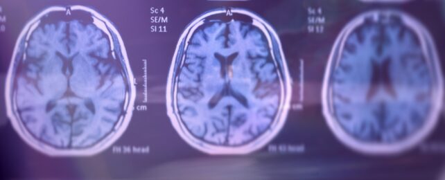 Three purple brain scans