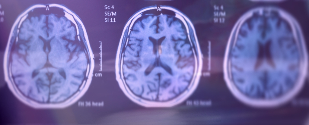 Nueva forma genética de Alzheimer identificada en personas con factor de riesgo común: Heaven32