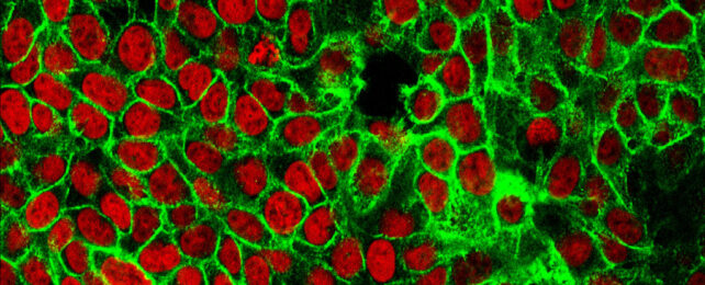 Human colon cancer cells with the cell nuclei stained red and the protein E-cadherin stained green