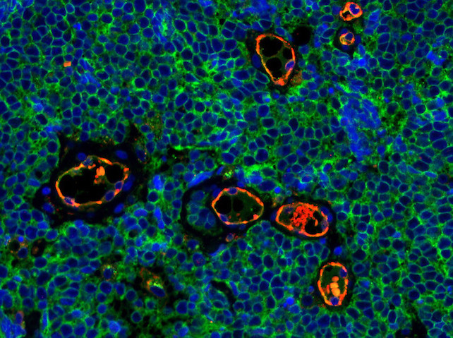 Merkel cell carcinoma tumor tissue