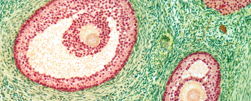 Un tratamiento para la malaria podría tener un efecto sorprendente en el síndrome de ovario poliquístico: Heaven32