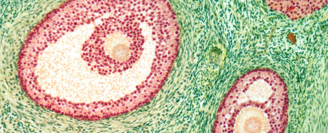 A Treatment For Malaria Could Have a Surprising Effect on PCOS