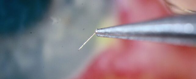 Horrific Bee Sting Leaves Barbed Stinger Hiding in a Man's Eyeball