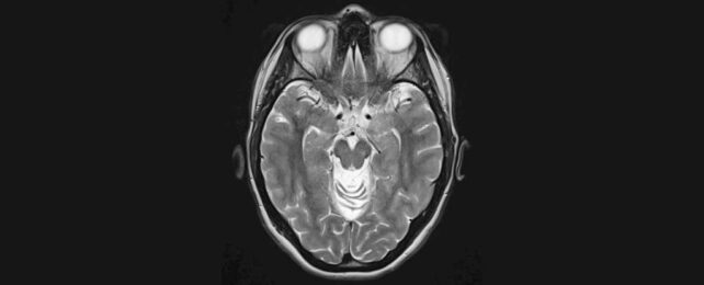 brain scan
