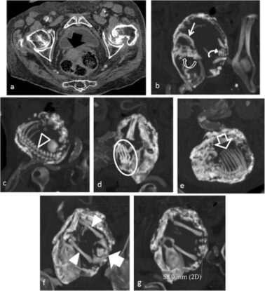 'Stone Baby': How The Rare Phenomenon Forms Inside The Body : ScienceAlert