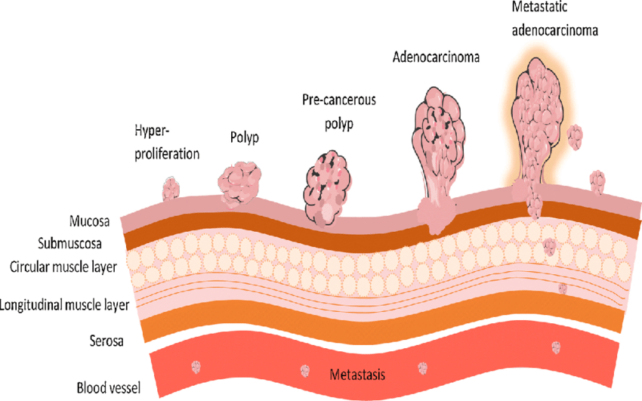 Colorectal Cancer
