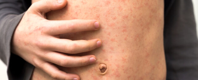 body with measles rash