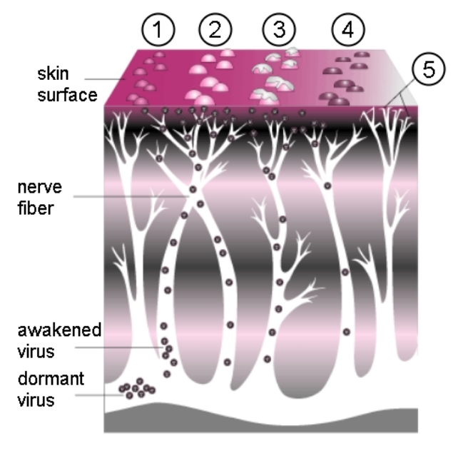 An illustration showing a dormant virus awakening and traveling through nerve fibers to skin.