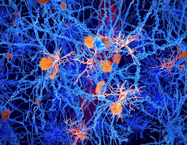 Illustration of amyloid plaques (orange) and microglia cells (red) among brain cells in a case of Alzheimer's disease.