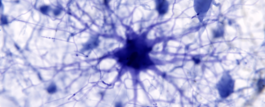 AI Discovers Suspected Trigger of Alzheimer's, And Maybe a Treatment