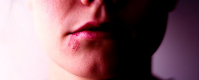 Herpes On Lip