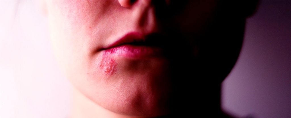 Herpes On Lip