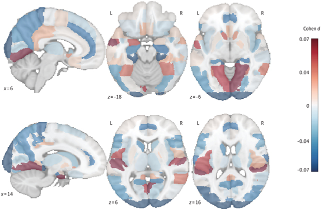 6 different angles of the brain showing color-coded structures.