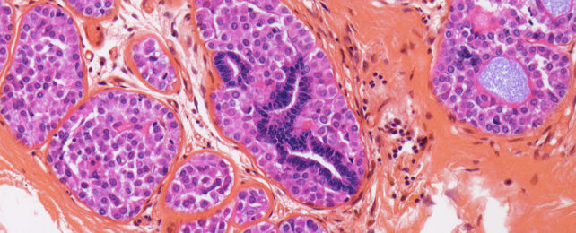 Breast cancer