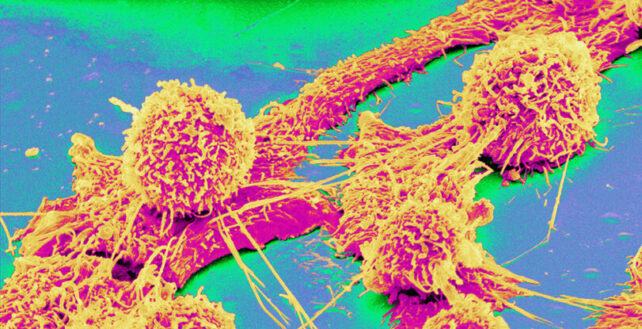 Scanning electron micrograph of a colon cancer cell, magnification x2000