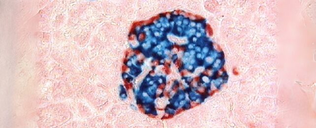 New Treatment May Cure Severe Type 1 Diabetes, Study Finds