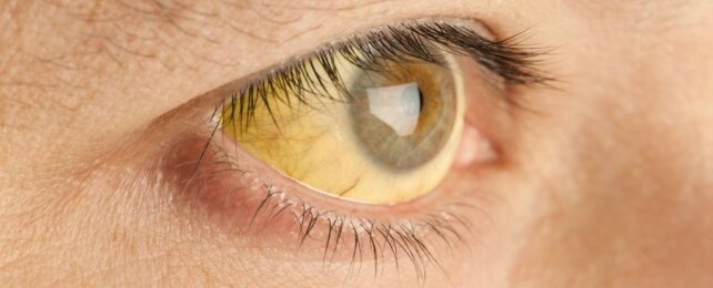 close-up photo of a human eyeball which has a slight yellow tinge in the whites of the eye