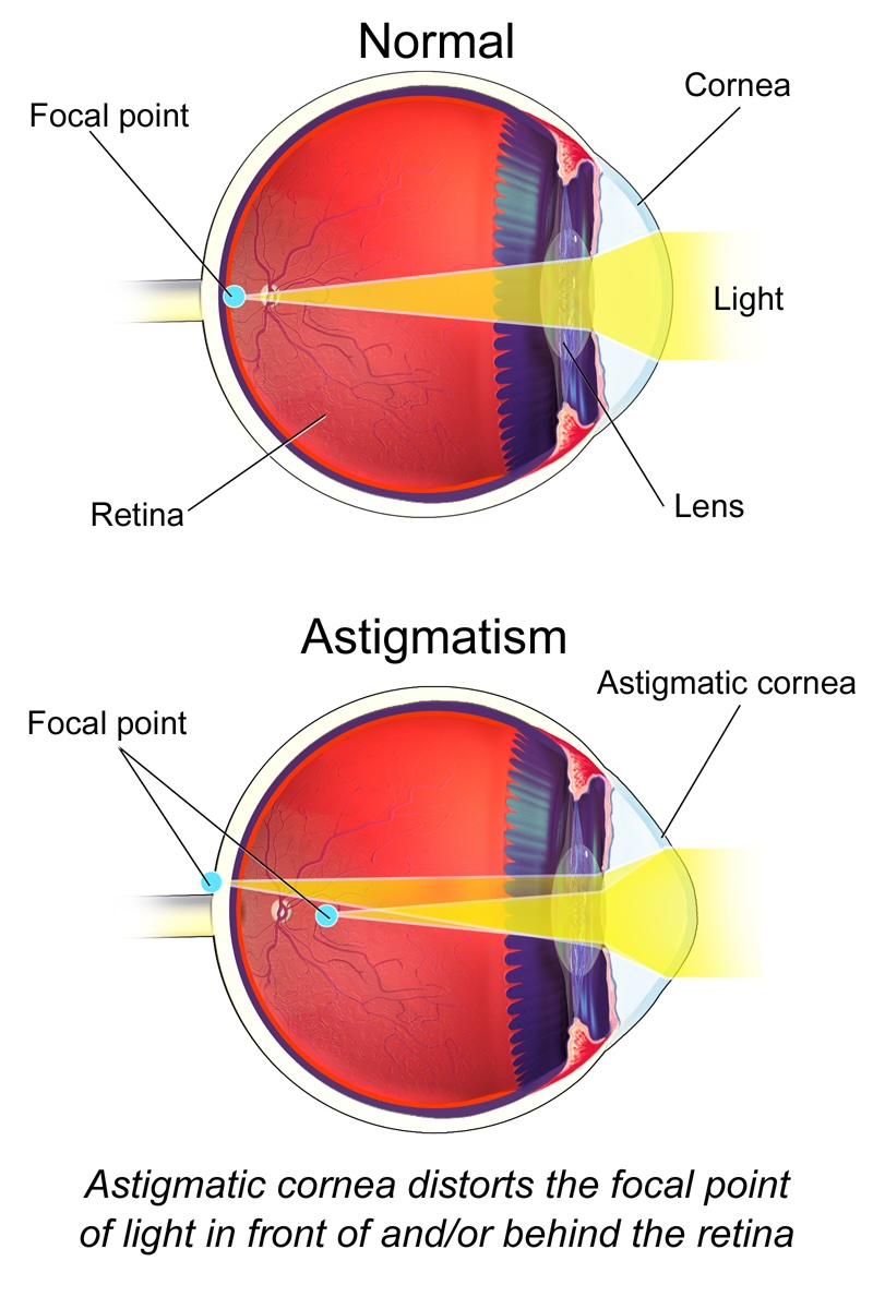 illustrated diagram showing a normal eye and eye with astigmatism (longer cornea). text below the images reads 'astigmatic cornea distorts the focal point of light in front of and/or behind the retina'