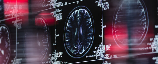 Brain scan