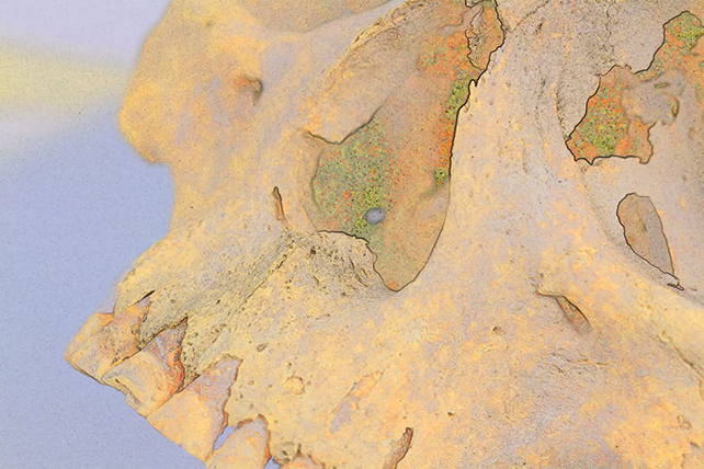 Leprosy skull