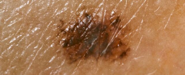 Modified Herpes Virus Found to Shrink Deadly Skin Cancers in Clinical Trial