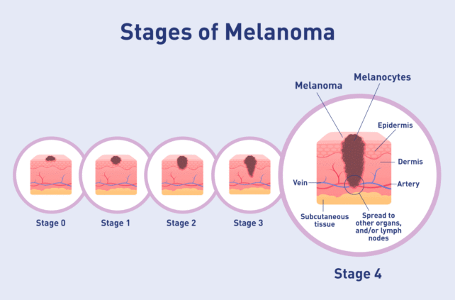 Advanced Melanoma