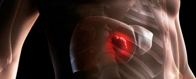 liver cancer illustration