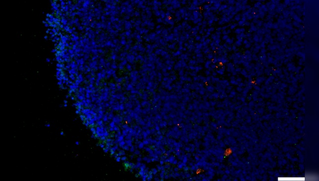 COVID Can Reason Alzheimer’s-Like Plaques in Eyes And Mind